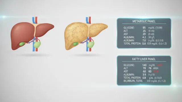 Side-by-side illustration of a smooth healthy liver and a pale fatty liver be